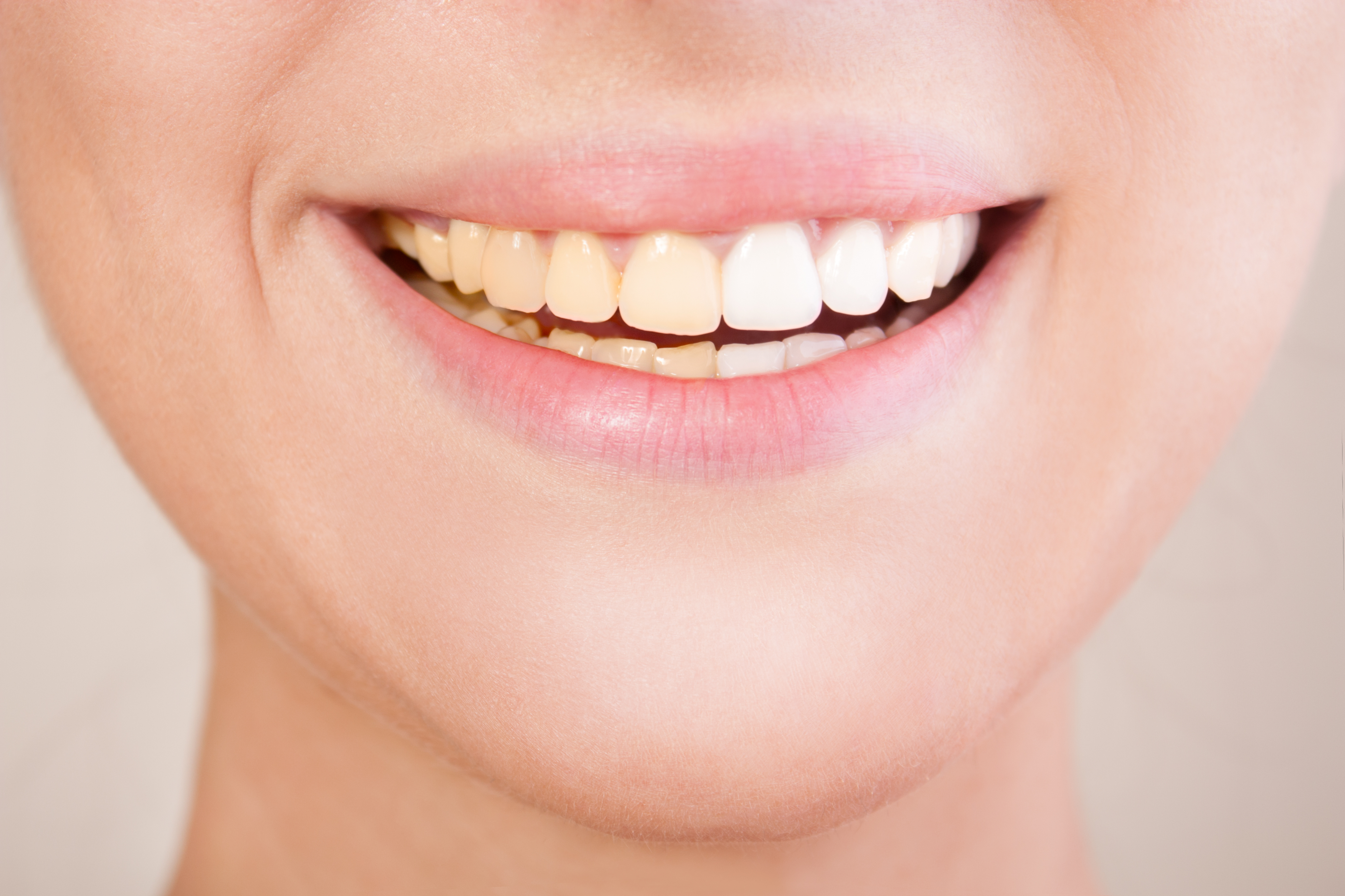 Descubre cuáles son las verdades y los mitos sobre el blanqueamiento dental.
