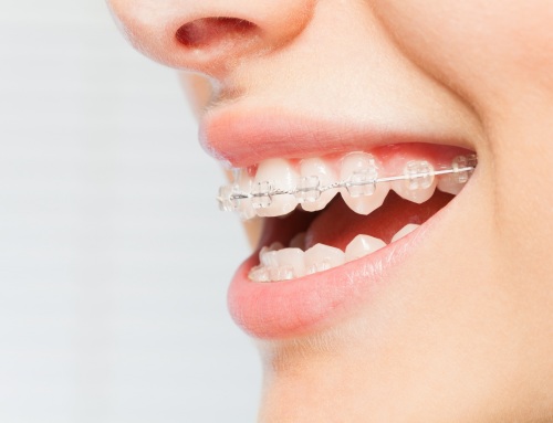 Retenedores en ortodoncia