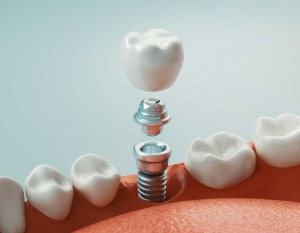 clínica dental en Santander, dentista en Santander, implantología en Santander
