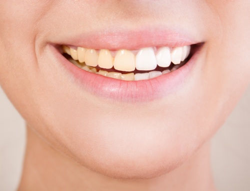 ¿Conoces estos mitos sobre el blanqueamiento dental?